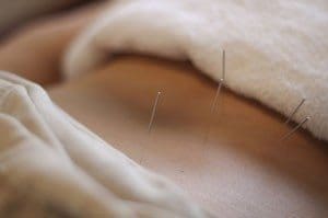acupuncture2