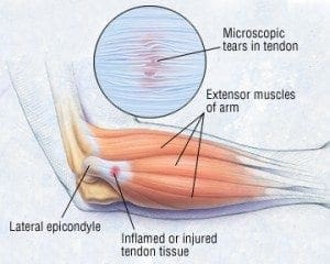 Tennis Elbow or Lateral Epicondylitis | Chiro Health & Rehab Centre, Concord West, Sydney