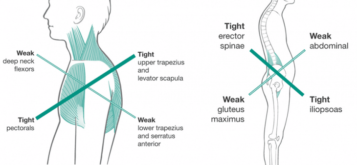upper-and-lower-crossed-syndrome1